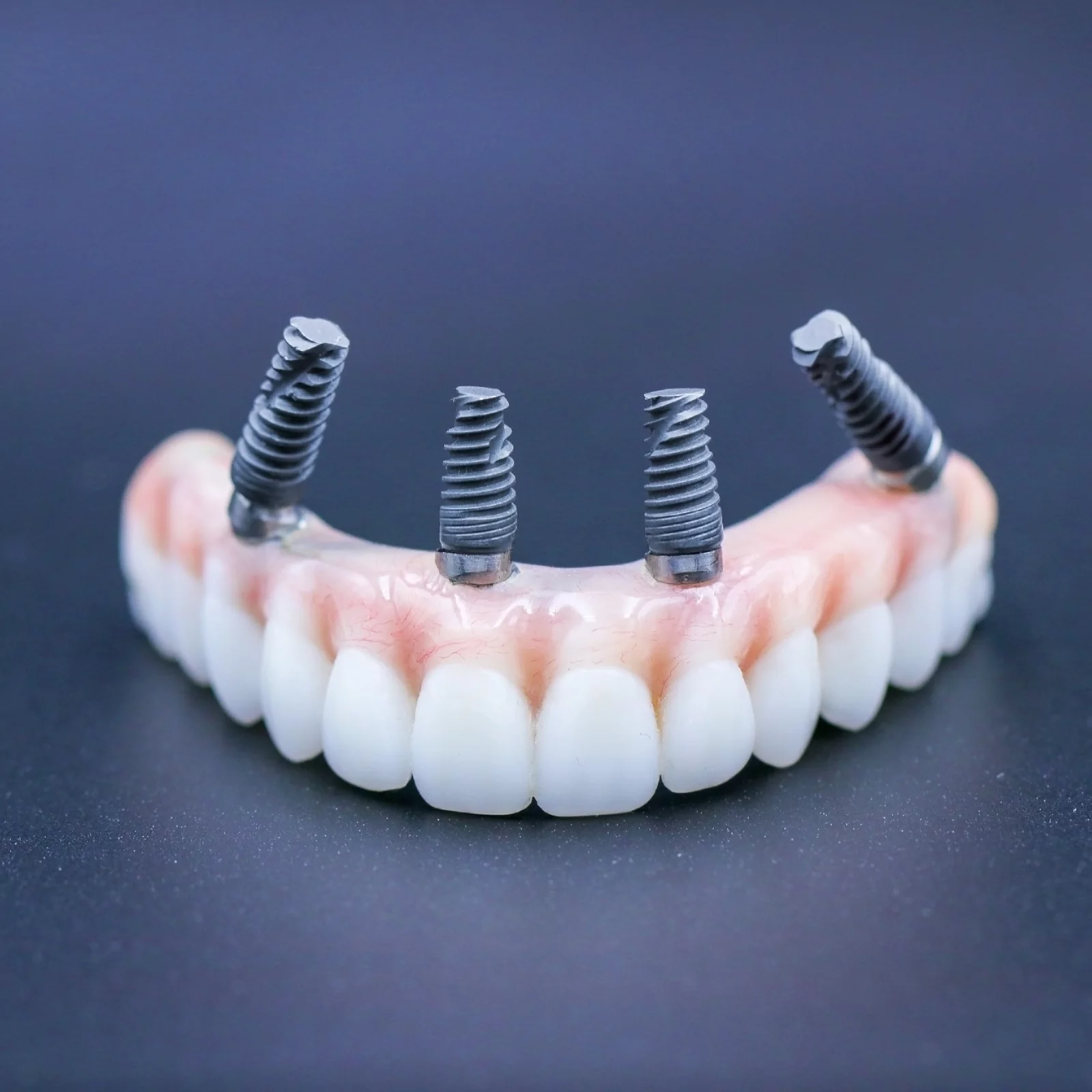 all-on-4-treatment-6